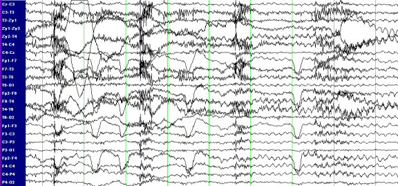 epilepsy eeg vs normal eeg